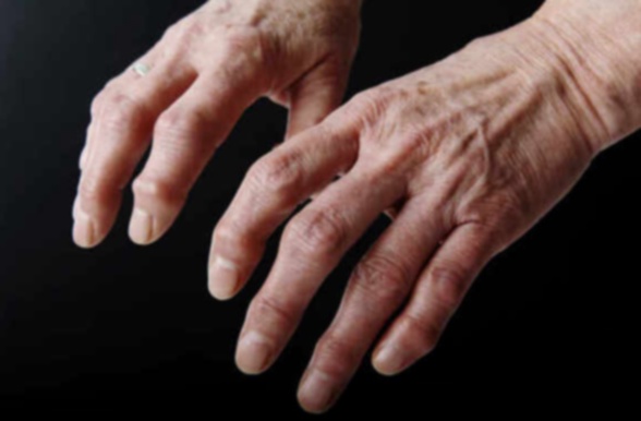 Acheter pommade pour arthrose des mains