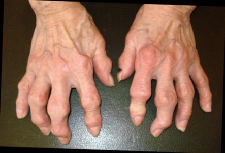 Arthrobiol Plus remède naturel