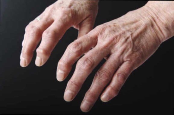 Artrobiol Plus remède naturel pour arthrose des doigts
