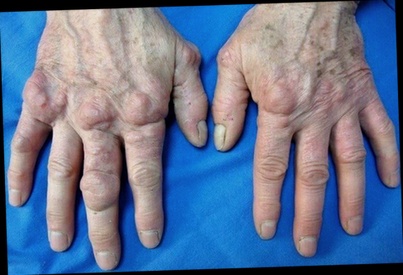 Remède arthrose genou naturel